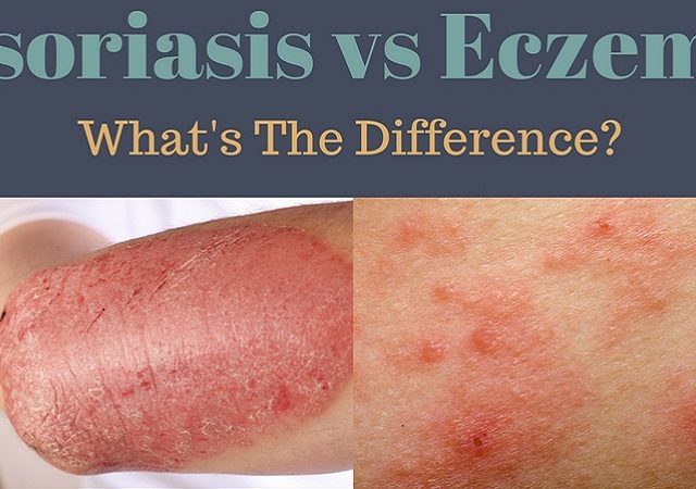 Psoriasis Vs Eczema - What's The Difference?