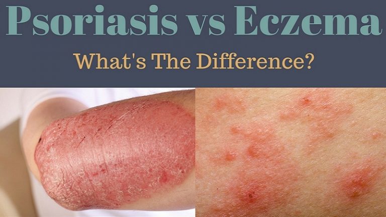 Psoriasis Vs Eczema 768x432 