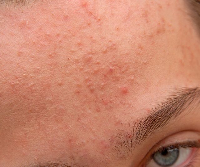 Natural Treatment Of Hormonal Acne