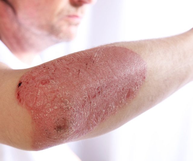 Person with plaque psoriasis on the elbow asking, does psoriasis go away on its own?
